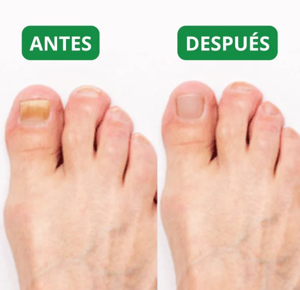 PediPatch® - 50 Parches Para Uñas Encarnadas