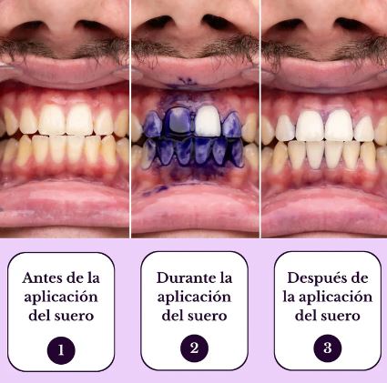 ¡SmileKit! - Blanqueador de Dientes Obsessive