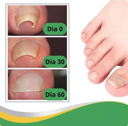 PediPatch® - 50 Parches Para Uñas Encarnadas