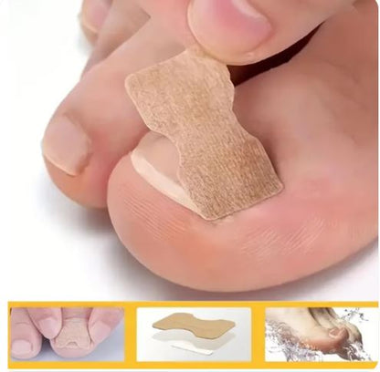 PediPatch® - 50 Parches Para Uñas Encarnadas
